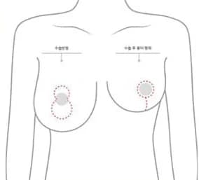 유륜 절개의 수술 방법과 수술 후 흉터가 남는 범위를 좌우로 비교한 그림