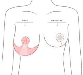 거상 절개의 수술 방법과 수술 후 흉터가 남는 범위를 좌우로 비교한 그림