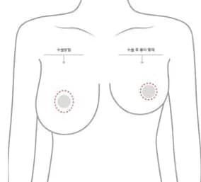 유륜 둘레를 원형으로 절개했을 때 흉터가 남는 범위를 표시한 그림