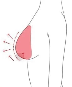 조직을 모아 올려 형태를 다시 잡는 방향 도해