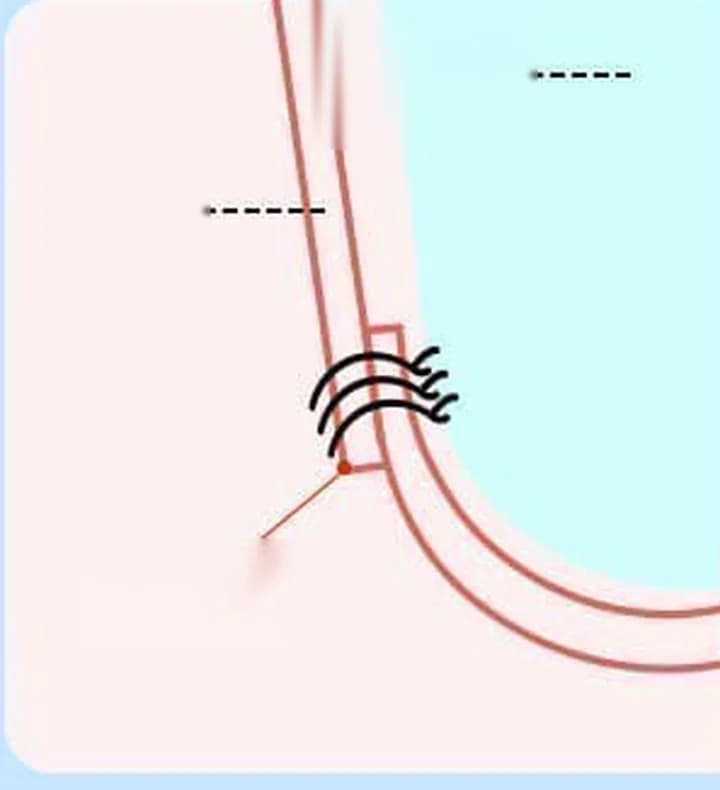 늘어난 가슴 아래 주름선을 봉합해 다시 잡는 방법을 표시한 그림