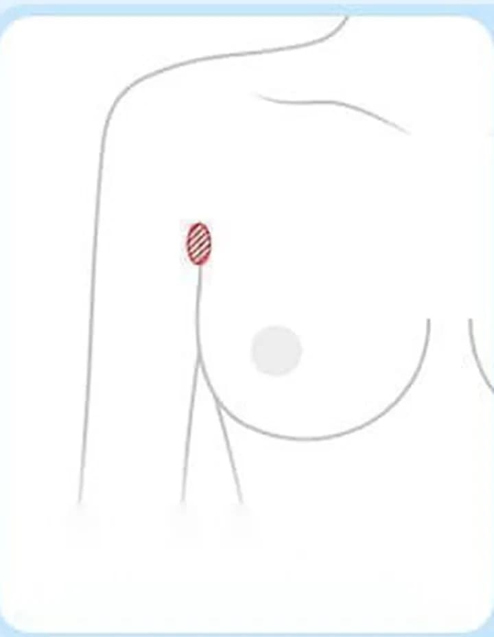 겨드랑이 주름을 따라 절개하는 위치를 표시한 그림