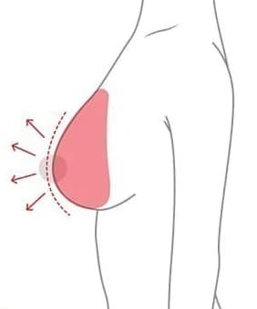늘어난 조직을 어느 방향으로 올리는지 표시한 그림