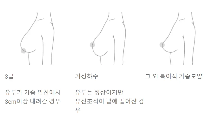 가슴거상수술비용? 가격 먼저 알아도 의미 없는 이유. — 본문 이미지 4