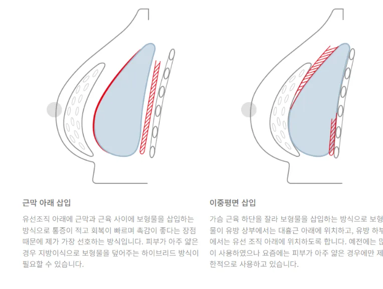 가슴수술모유수유, 모양 처짐으로 수술을 미룰까 고민하는 분께<20년 연구경험으로 드리는 조언> — 본문 이미지 5