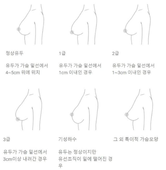출산후처진가슴, 수술 대신 간단한 시술은 없을까요? <20년간 가슴성형을 연구한 의료진의 답변> — 본문 이미지 4