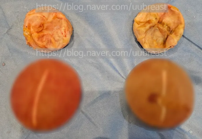 가슴보형물제거술, 피막까지 함께 제거해야 되는 건 아닐까? <20년의 연구 경험으로 드리는 조언> — 본문 이미지 5