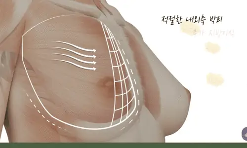 새가슴수술, 성형하면 골만 없고 사이즈만 커지지 않을까 <20년의 연구경험으로 드리는 조언> — 본문 이미지 4