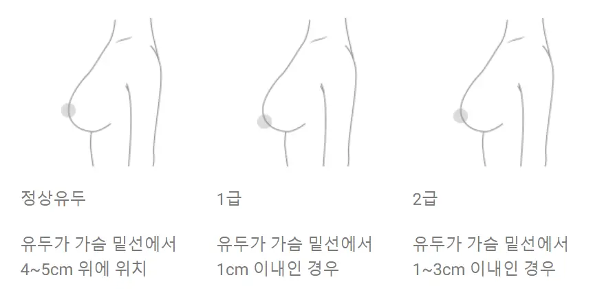 가슴거상수술비용? 가격 먼저 알아도 의미 없는 이유. — 본문 이미지 3