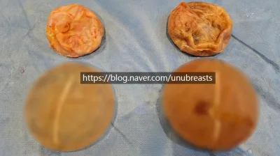 모티바가격? 재수술 걱정된다면 병원 선택 시 2가지 기준 살펴보세요.〈작년 모티바 보형물 최다 사용 병원 작성〉 — 본문 이미지 8