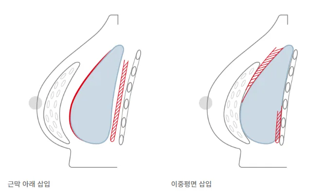 출처: 유앤유 홈페이지 https://www.unups.co.kr/body-main/small-breast/