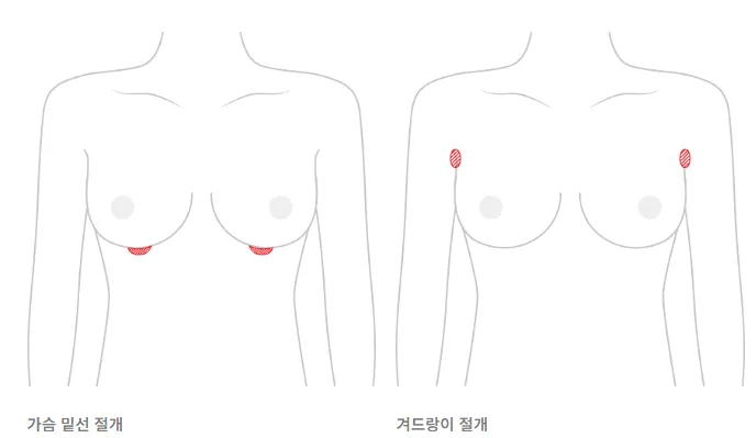 출처: 유앤유 홈페이지 https://www.unups.co.kr/body-main/small-breast/