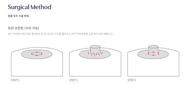 유두성형,함몰유두 자연스럽게 좋아질까?<20년간 가슴성형만을 연구한 의료진 작성> — 본문 이미지 4