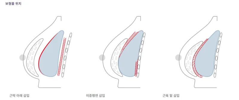 서울가슴수술 상담만 6번? 3,404건 보형물 이식한 데이터로 본 병원 선택기준 — 본문 이미지 7
