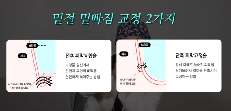가슴재수술시기, 밑빠짐으로 재수술 고민이라면 필독 <20년간 가슴성형만을 연구한 의료진 작성> — 본문 이미지 7