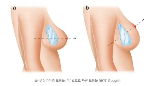 가슴확대수술비용 400~1000만원대? 대체 뭐가 맞는 걸까 < 20년 연구경험으로 드리는 조언 > — 본문 이미지 20