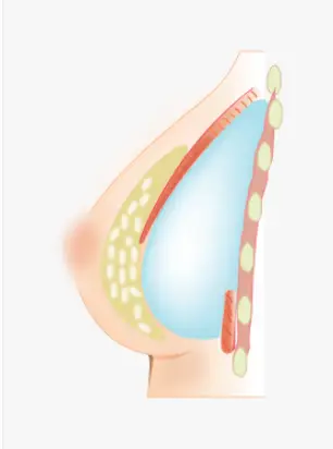 이중평면, 근육을 자른다던데 괜찮을까? <운동 부작용 연구결과로 드리는 조언> — 본문 이미지 5