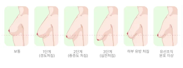 출산후가슴수술, 완모 후 빠진 가슴 다시 봉긋해질 수 있을까(20년간 가슴성형만 연구하며 깨달은 것) — 본문 이미지 7