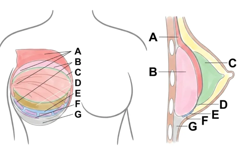 절벽가슴 수술, 보형물 들어가면 어색하지 않을까?<실제 연구 자료 2편으로 드리는 조언> — 본문 이미지 7