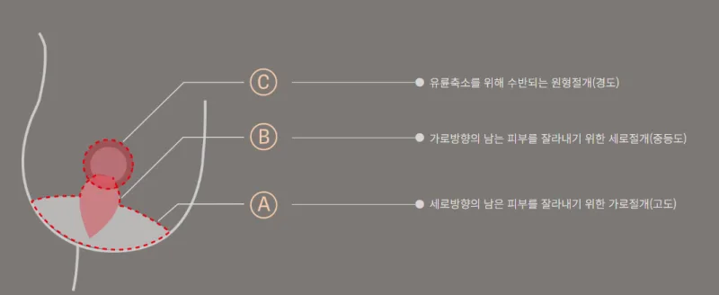 가슴거상수술, 처진 가슴은 무조건 리프팅 해야될까?<402명을 대상으로 한 연구자료 첨부> — 본문 이미지 5