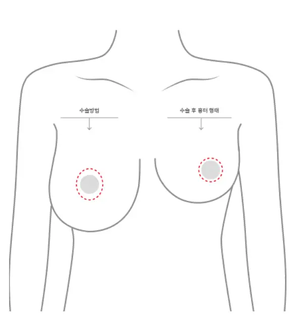 가슴축소수술비용, 절개방법까지 모두 공개합니다. <20년의 연구경험으로 드리는 조언> — 본문 이미지 4