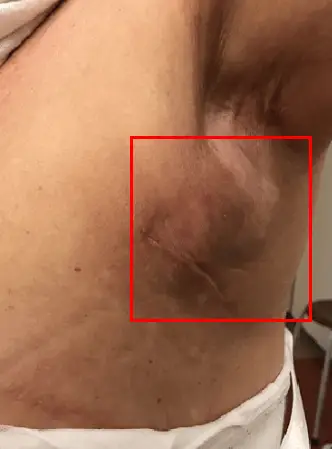 가슴수술 회복기간, 1주일 이상 지연시킬 수 있는 합병증 2가지 <20년의 연구경험으로 드리는 조언> — 본문 이미지 7