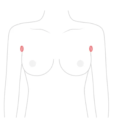 가슴성형흉터, 절개 부위마다 다를까? <20년간 가슴 성형을 연구한 의료진의 조언> — 본문 이미지 4
