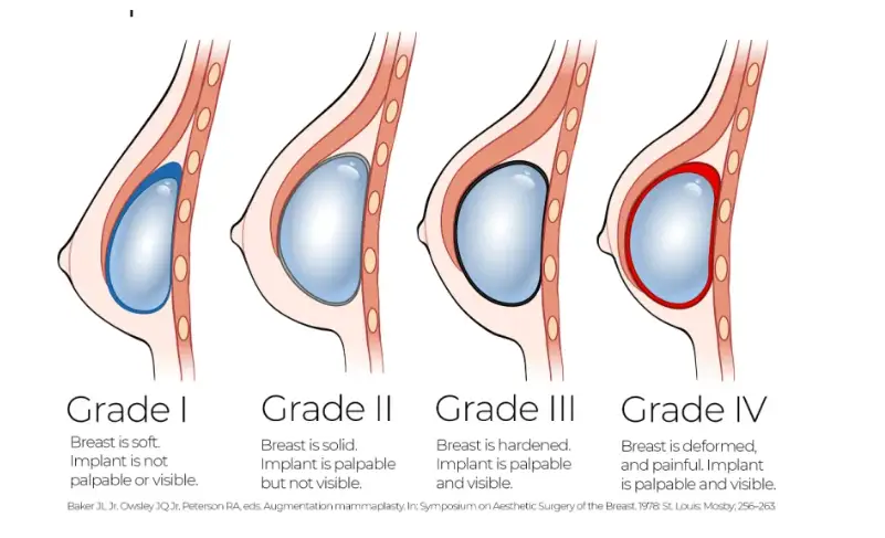 가슴성형구형구축? 20년간 연구했던 경험을 바탕으로 한 조언 — 본문 이미지 4
