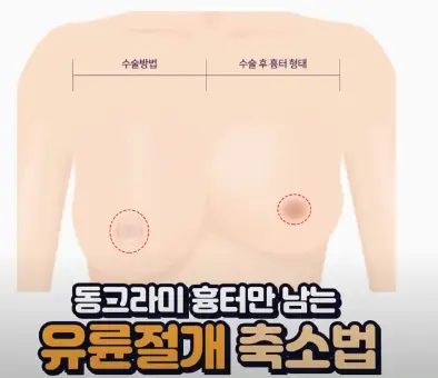 가슴축소술, 사이즈별 절개 방법까지 20년의 연구 경험으로 알려드립니다. — 본문 이미지 4