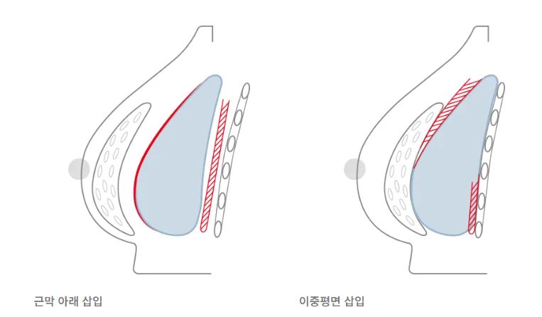 절벽가슴 수술, 보형물 들어가면 어색하지 않을까?<실제 연구 자료 2편으로 드리는 조언> — 본문 이미지 5