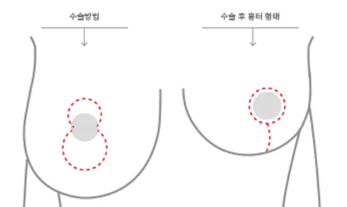 처진가슴수술비용, 거상술 / 보형물이 필요한 경우도 정리해드리겠습니다. <20년의 연구경험으로 드리는 조언> — 본문 이미지 5
