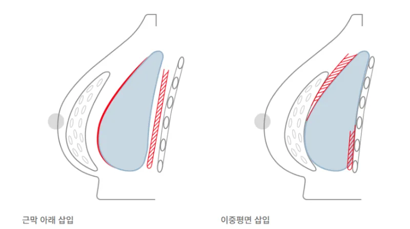 가슴재수술병원, 대형 병원 가면 해결될까?<20년 연구 경험으로 드리는 조언> — 본문 이미지 5