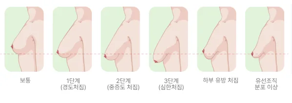 윗가슴꺼짐, 지방이식/필러가 답이 될 거라는 착각 <작년 3,404건 보형물 이식한 병원 작성> — 본문 이미지 6