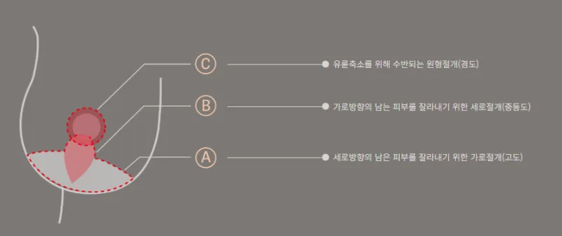 스몰 i 리프팅 원리