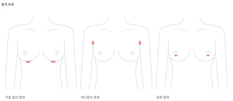 가슴확대수술비용, 병원마다 차이 나는 이유?<보형물 3,023건 수술한 병원에서 알려드립니다> — 본문 이미지 5