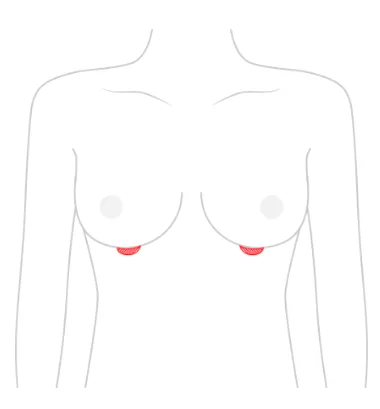 가슴성형흉터, 절개 부위마다 다를까? <20년간 가슴 성형을 연구한 의료진의 조언> — 본문 이미지 5