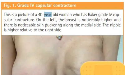 가슴구형구축 시기, 증상? 82편의 논문을 분석하여 소개합니다. — 본문 이미지 7