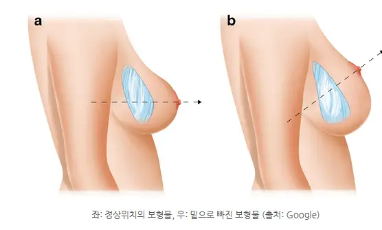 가슴밑빠짐, 원인/예방법까지 20년의 연구 경험을 토대로 말씀드립니다. — 본문 이미지 2
