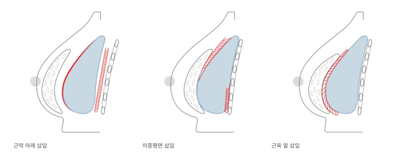 모티바미니 vs 데미 고민 전에 먼저 확인해 볼 2가지<작년 모티바 최다 사용병원 작성> — 본문 이미지 6