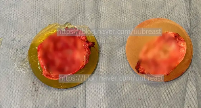 피막제거? 비용이 약 2배 차이 날 수 있는 경우에 대하여 <20년의 연구 경험으로 드리는 조언> — 본문 이미지 9