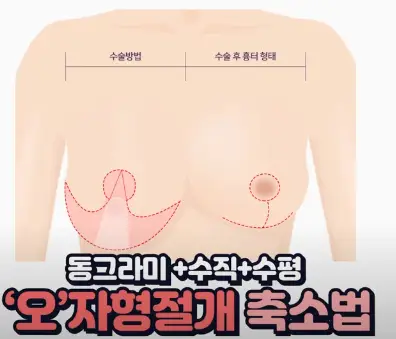가슴축소술, 사이즈별 절개 방법까지 20년의 연구 경험으로 알려드립니다. — 본문 이미지 6