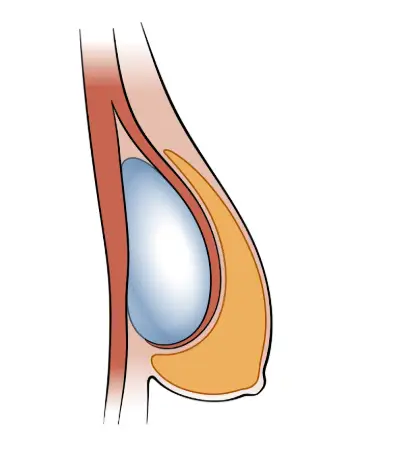 출산후가슴처짐, 윗 가슴만 보형물로 채우면 될 거라는 착각? — 본문 이미지 5