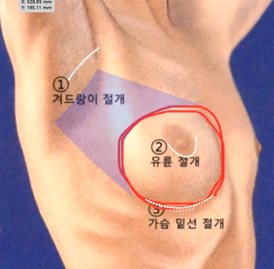 파란 영역이 박리범위 (겨절의 경우)