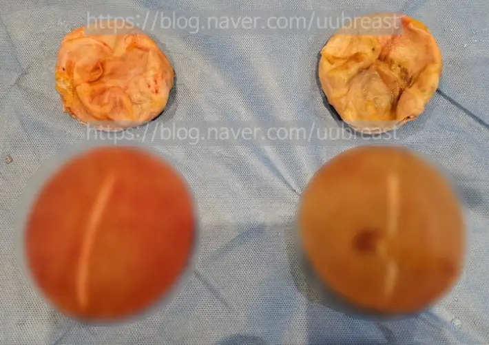 피막제거? 비용이 약 2배 차이 날 수 있는 경우에 대하여 <20년의 연구 경험으로 드리는 조언> — 본문 이미지 7