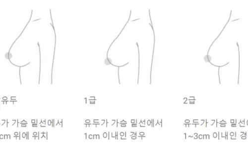 처진가슴수술후기? 속지 마세요. — 본문 이미지 12