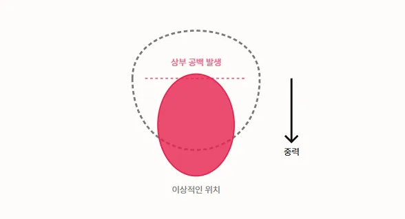 가슴재수술시기
