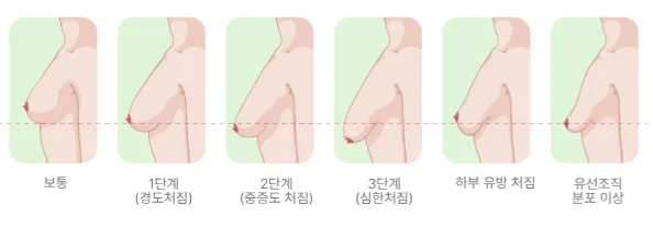 가슴처짐단계 셀프 체크리스트