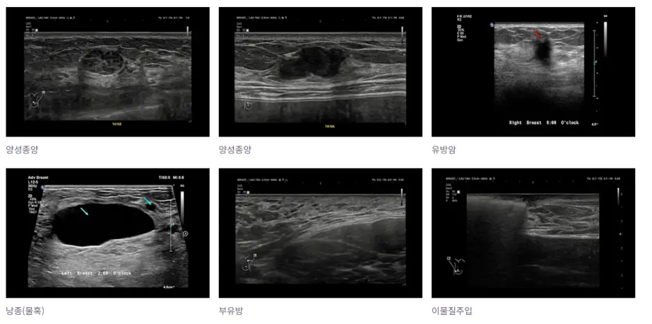 강남가슴성형외과? 작년 3000건 이상 수술한 곳이 추천하는 곳의 특징 2가지. — 본문 이미지 14