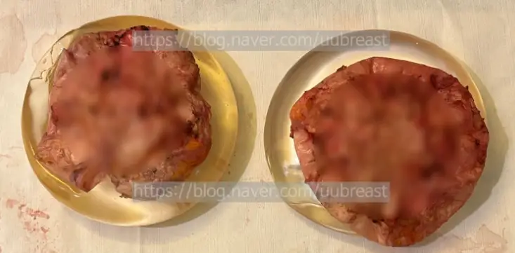 피막제거? 비용이 약 2배 차이 날 수 있는 경우에 대하여 <20년의 연구 경험으로 드리는 조언> — 본문 이미지 8