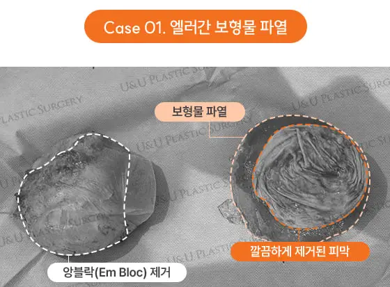 엘러간보형물, 보상받으면 무조건 교체? 대체 어쩌면 좋을까 <20년의 연구 경험으로 드리는 조언> — 본문 이미지 9